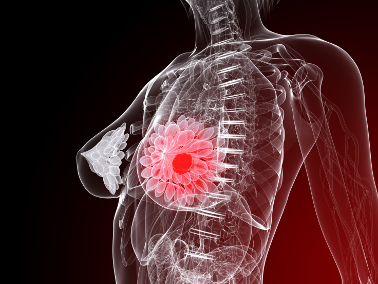 Breast Cancer Hormone Therapy