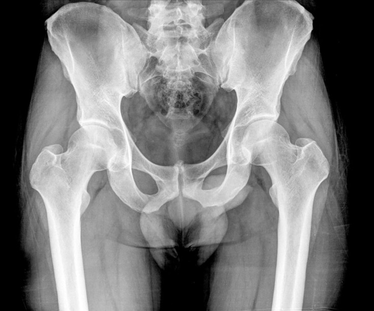 pelvic xray