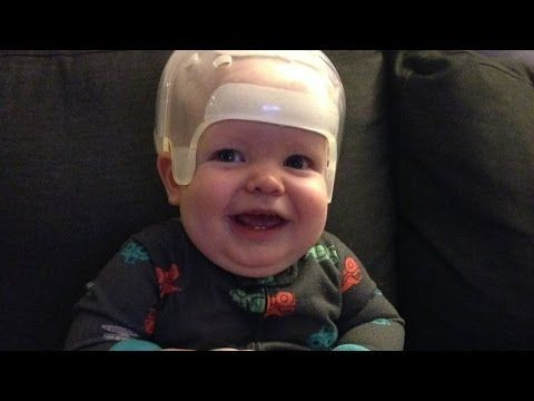 What Is Craniosynostosis? Doctor Finds Baby's Misshapen Head Is Actually Something Much More Dangerous