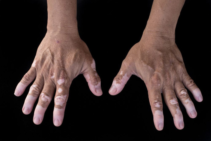 Vitiligo