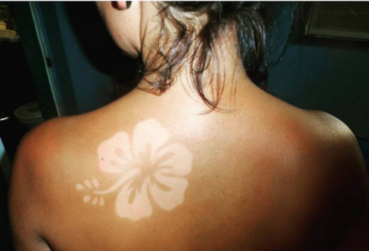 sunburn art