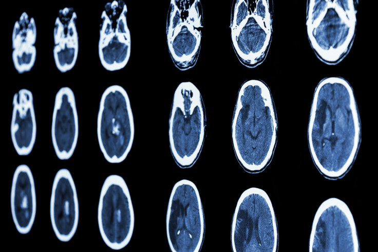 Intracranial Hemorrhage