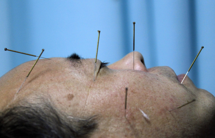 acupuncture