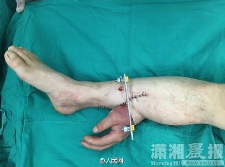 Severed hand grafted to ankle