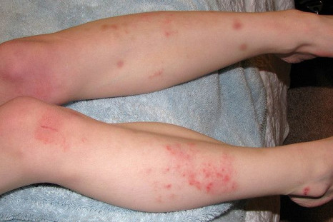 The picture illustrates skin rashes caused by eczema.