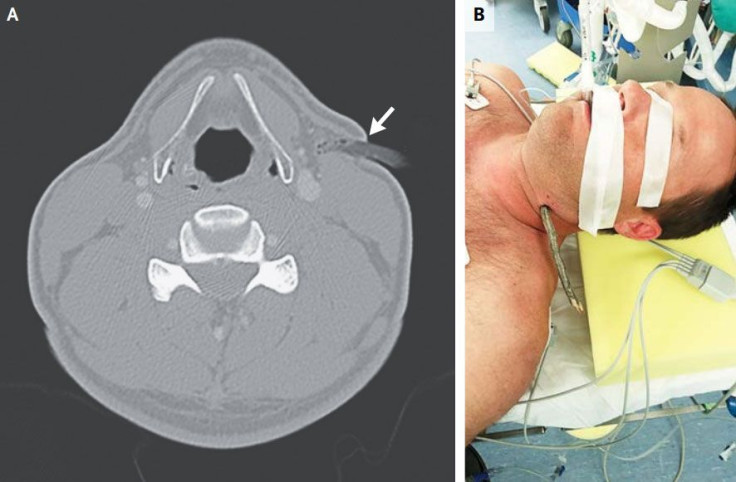 Cyclist Impaled