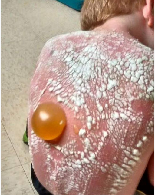 sunburn 2