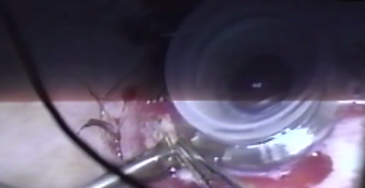 Bionic eye implant