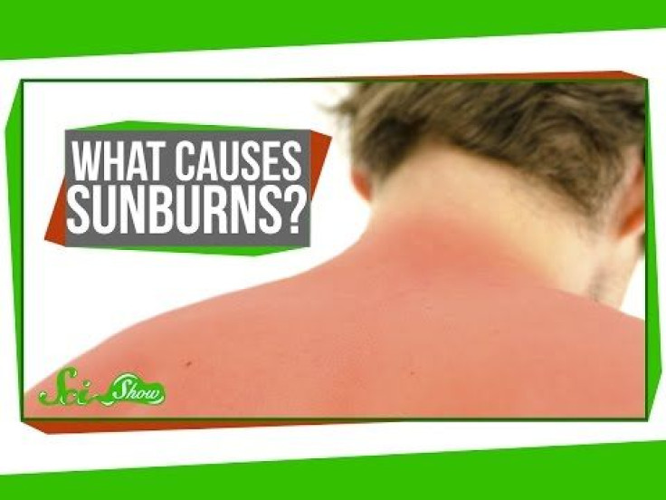 Just Why Do We Get Sunburns Anyhow?