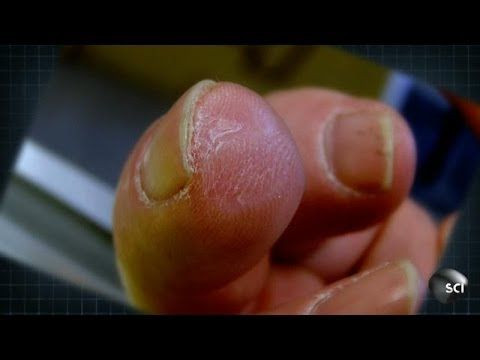 'Magical Pixie Dust' From Pig's Bladder Helps Man Regrow Human Tissue On Severed Finger
