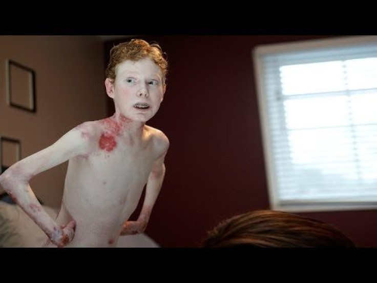 Butterfly Boy Raises Awareness Of Epidermolysis, Rare Condition That Causes Skin To Fall Off