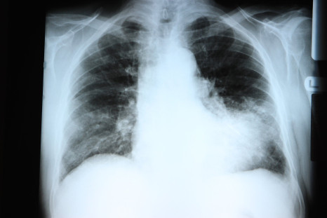 Symptoms of pneumonia can range from mild to life-threatening.
