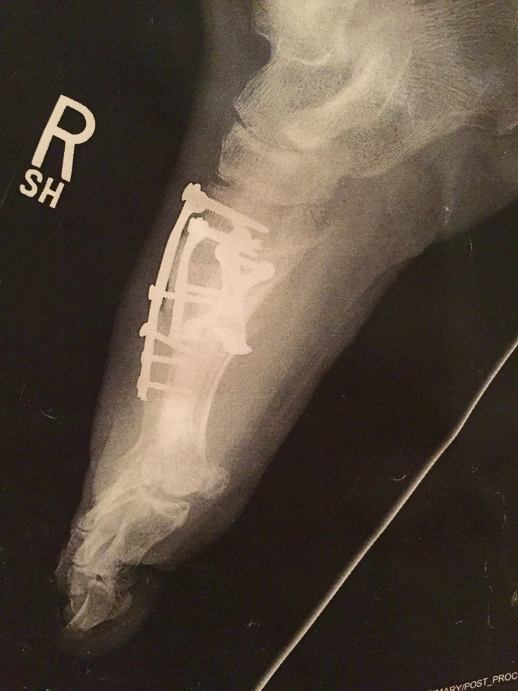 Screws in foot