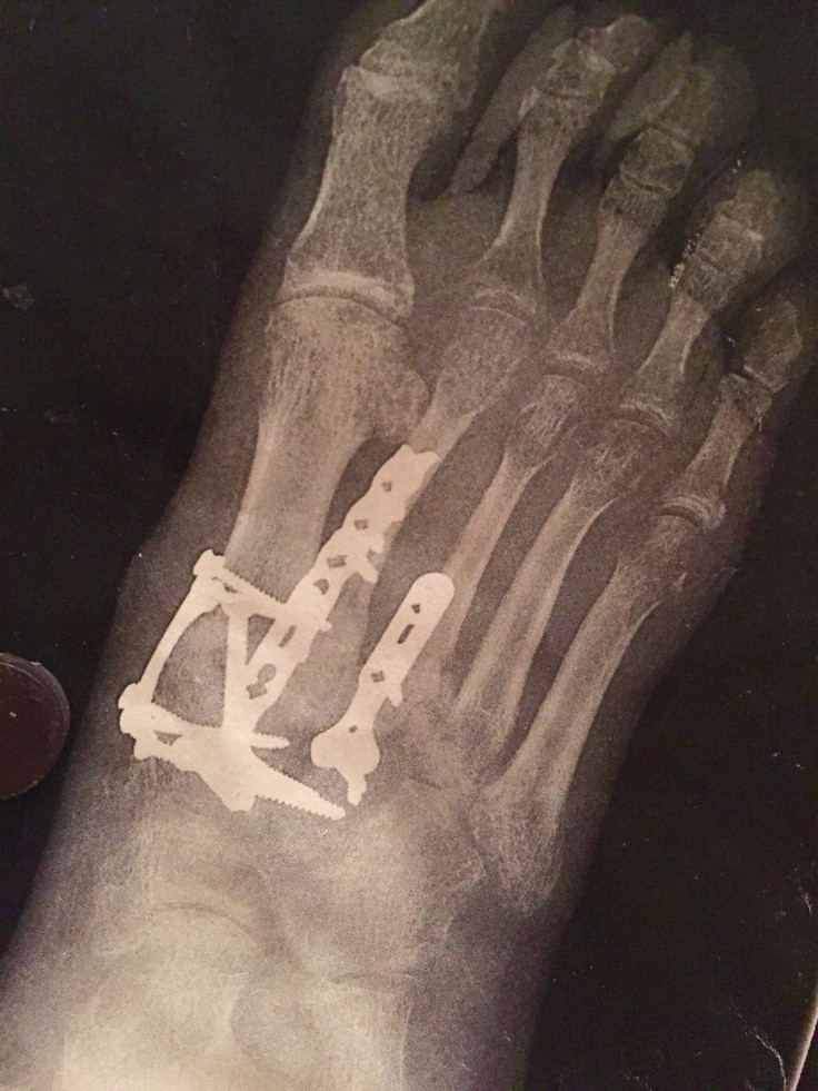 Screws in man's foot