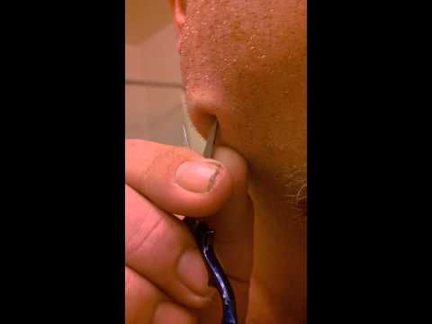 DIY Dental Care: Man Pops Tooth Abscess With Scissors Near Lower Jaw For Pain Relief