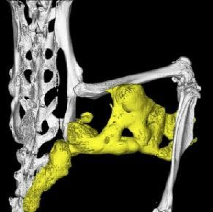 Heterotopic Ossification