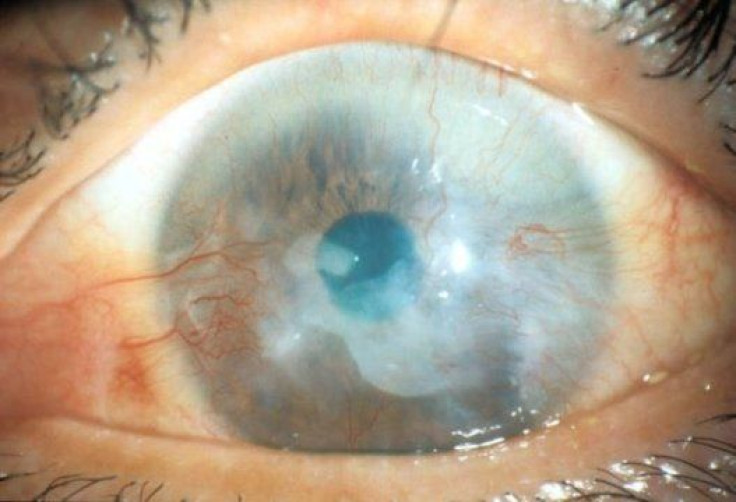 Limbal Stem Cell Deficiency