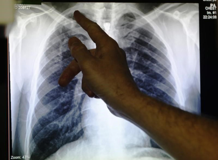 Tuberculosis