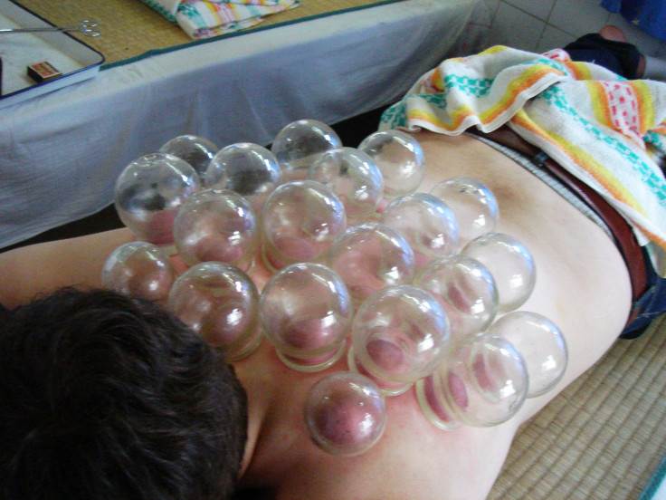 Cupping Therapy Back