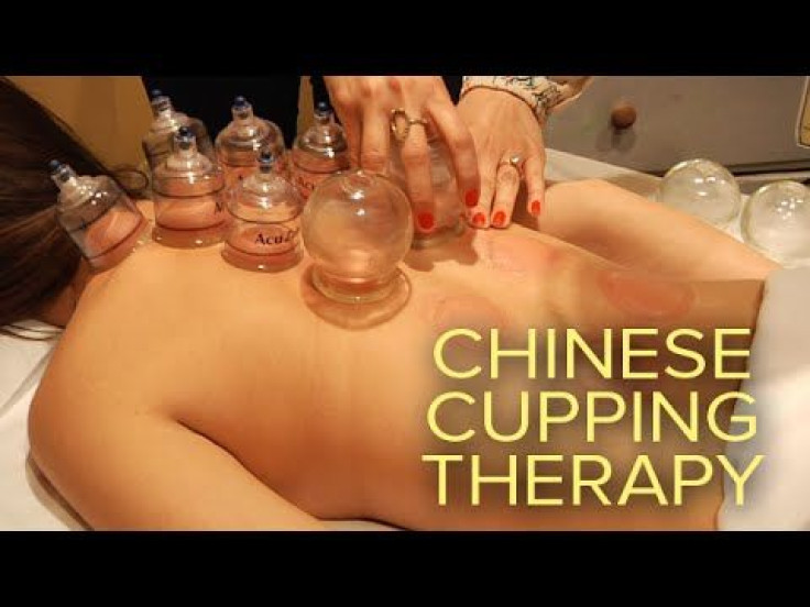 What Are All Those Red Spots? Traditional Chinese Cupping Therapy Provides Pain Relief And Reduces Muscle Aches