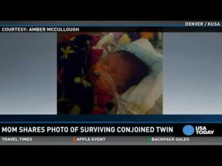 The Girl Who Lived: Minnesota Mother Shares Photo Of Conjoined Twin That Survived 5-Hour Surgery