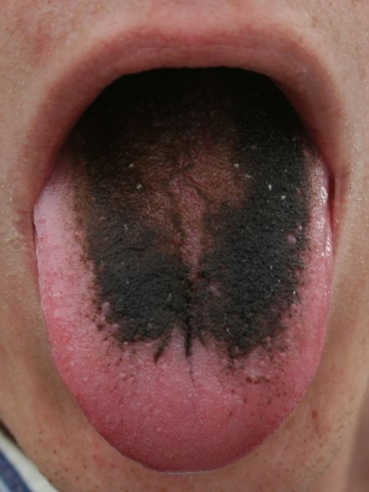 Black Hairy Tongue