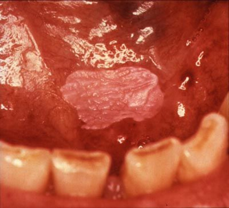 Leukoplakia