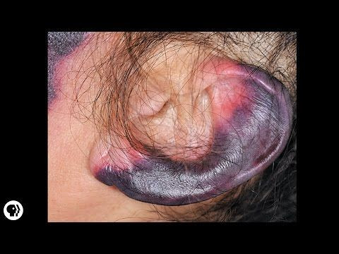 Don’t Do Drugs: Newest Cocaine Side Effects Involves Rotting Of The Skin Especially Your Earlobes