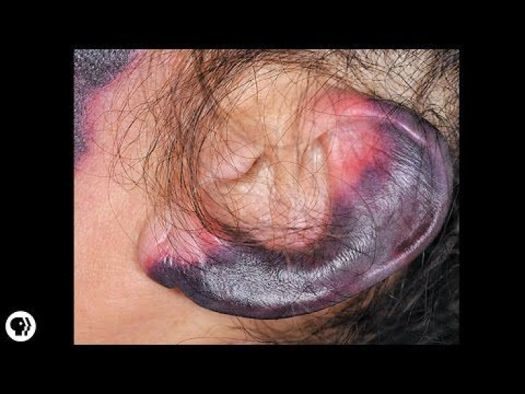 Don’t Do Drugs: Newest Cocaine Side Effects Involves Rotting Of The Skin Especially Your Earlobes 