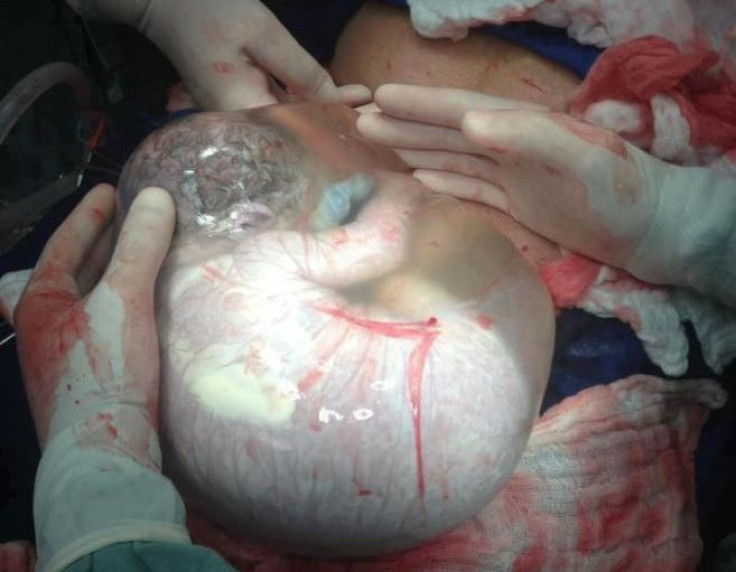 Amniotic sac