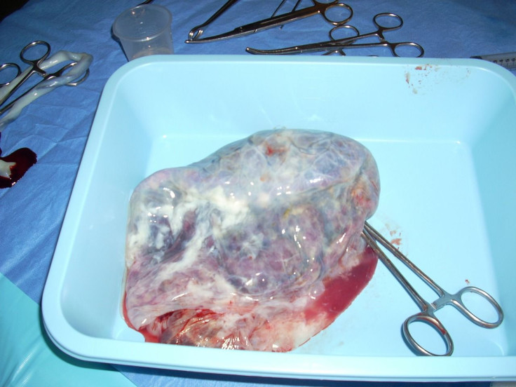 Placenta