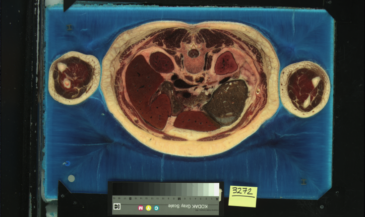 Digital image of cadaver