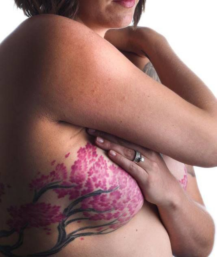 mastectomy