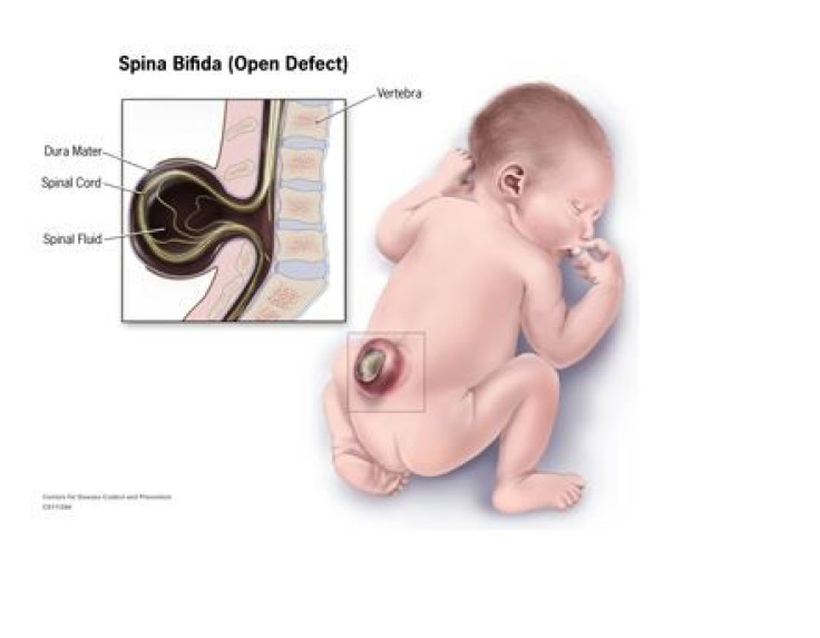 Spina bifida