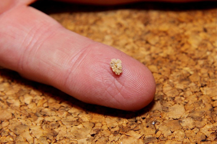 Kidney Stone 