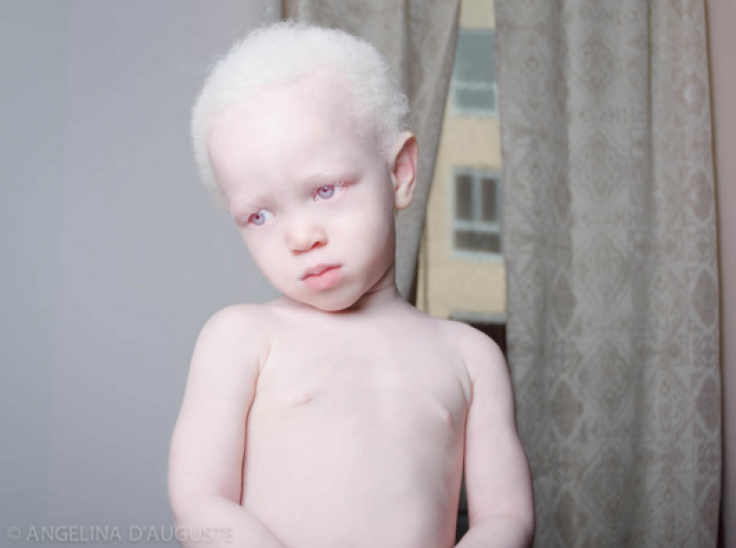 albino 1
