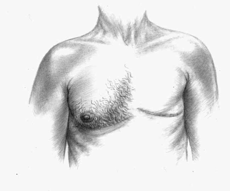 Man With Breast Cancer 