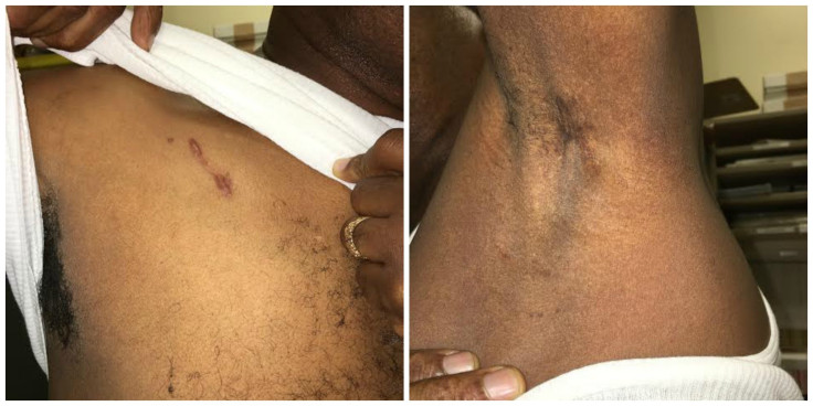 Man With Breast Cancer