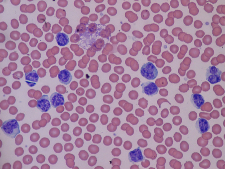 Lymphocytosis