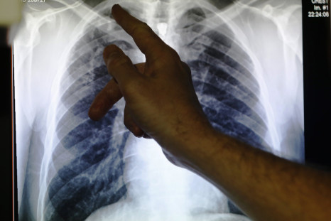 Clinical lead Doctor Al Story points to an x-ray showing a pair of lungs infected with TB (tuberculosis) during an interview with Reuters on board the mobile X-ray unit screening for TB in Ladbroke Grove in London January 27, 2014.