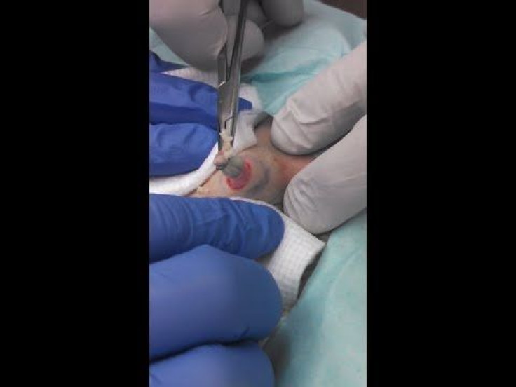 Cyst Removal: Man's Gets Massive Cyst Squeezed From Back, Leaving Large Hole