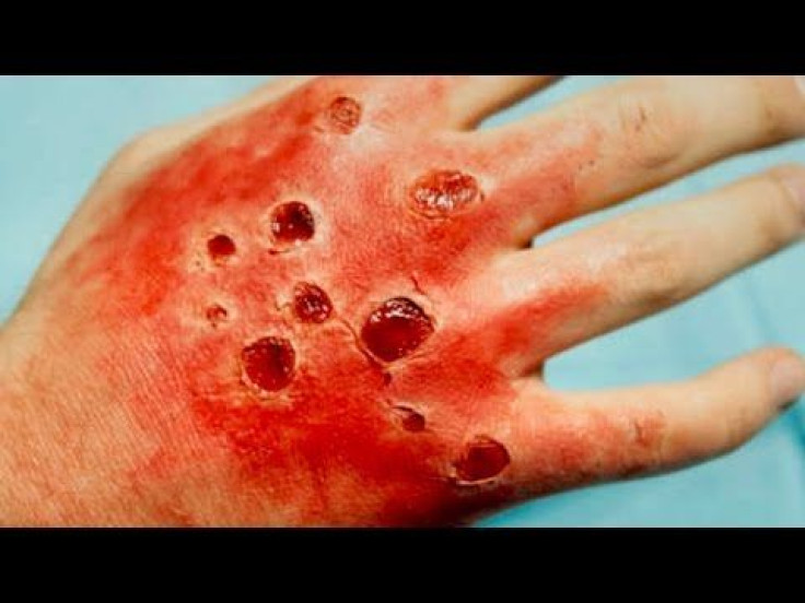 World’s Deadliest Diseases: All 10 Of These Diseases Can Kill You In 24 Hours