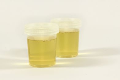 A photo of urine samples.