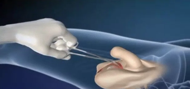 Male To Female Sex Reassignment Surgery Watch A Reconstruction And