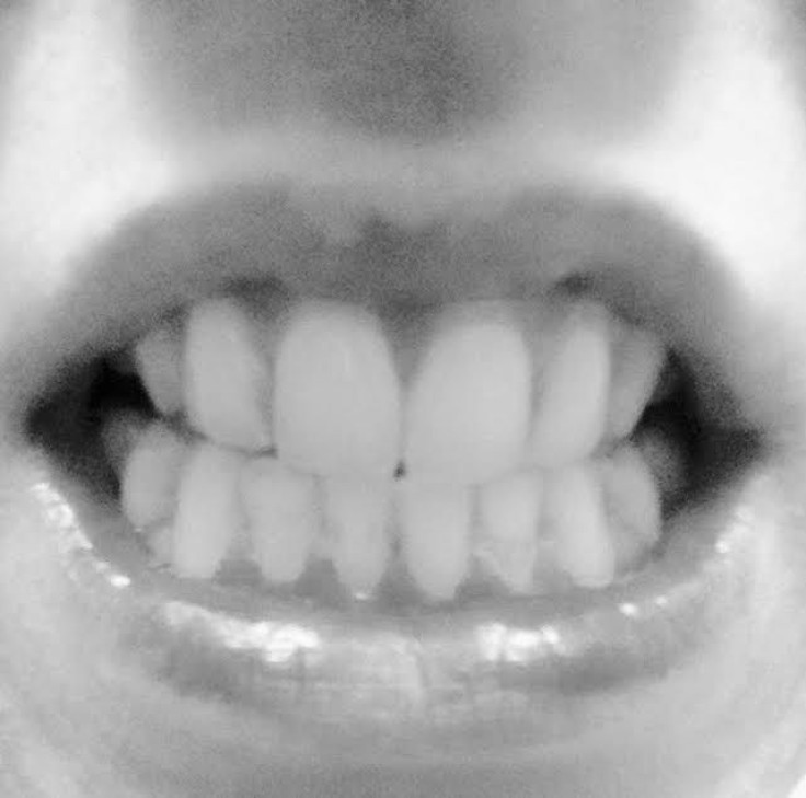 Teeth before oil pulling