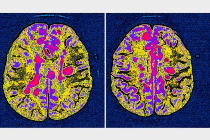 Multiple Sclerosis Scan