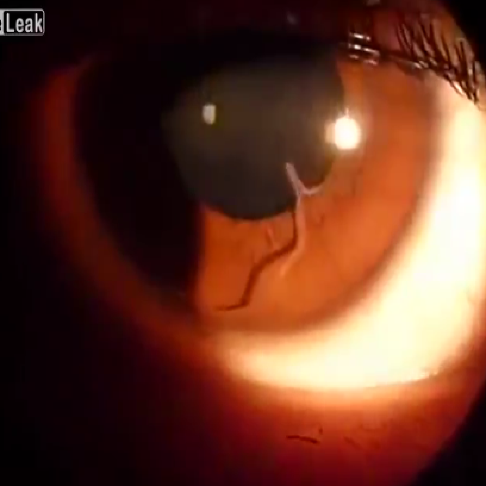 Roundworm Eye Roundworms In Human Eye Toxocariasis | Sweden| PDF | PPT| Case Reports