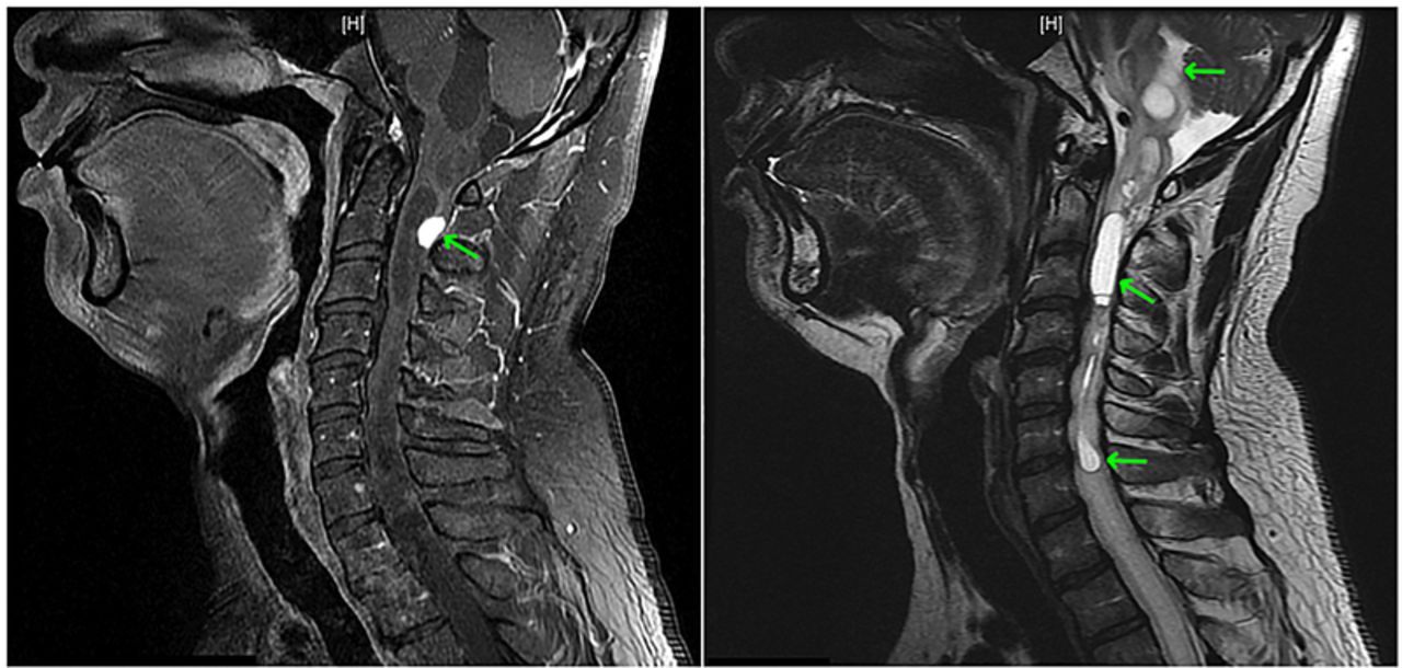 Man’s Uncontrollable Hiccups For 5 Days Reveal Massive Tumor On His ...