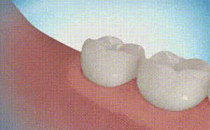 Wisdom tooth removal - Imgur