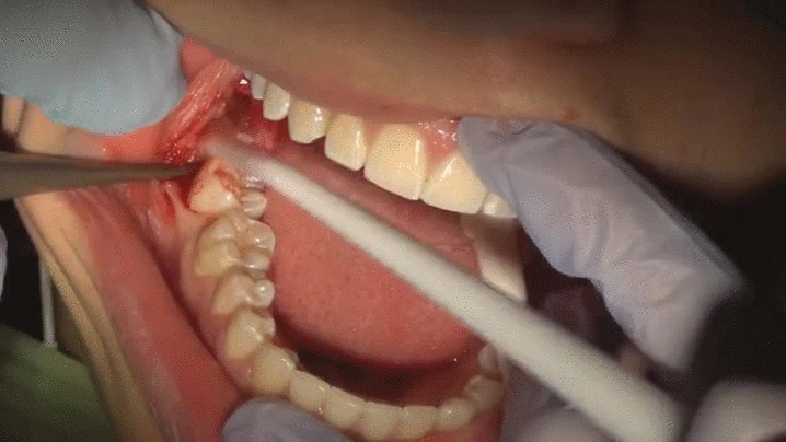 Cool wisdom tooth extraction - Imgur